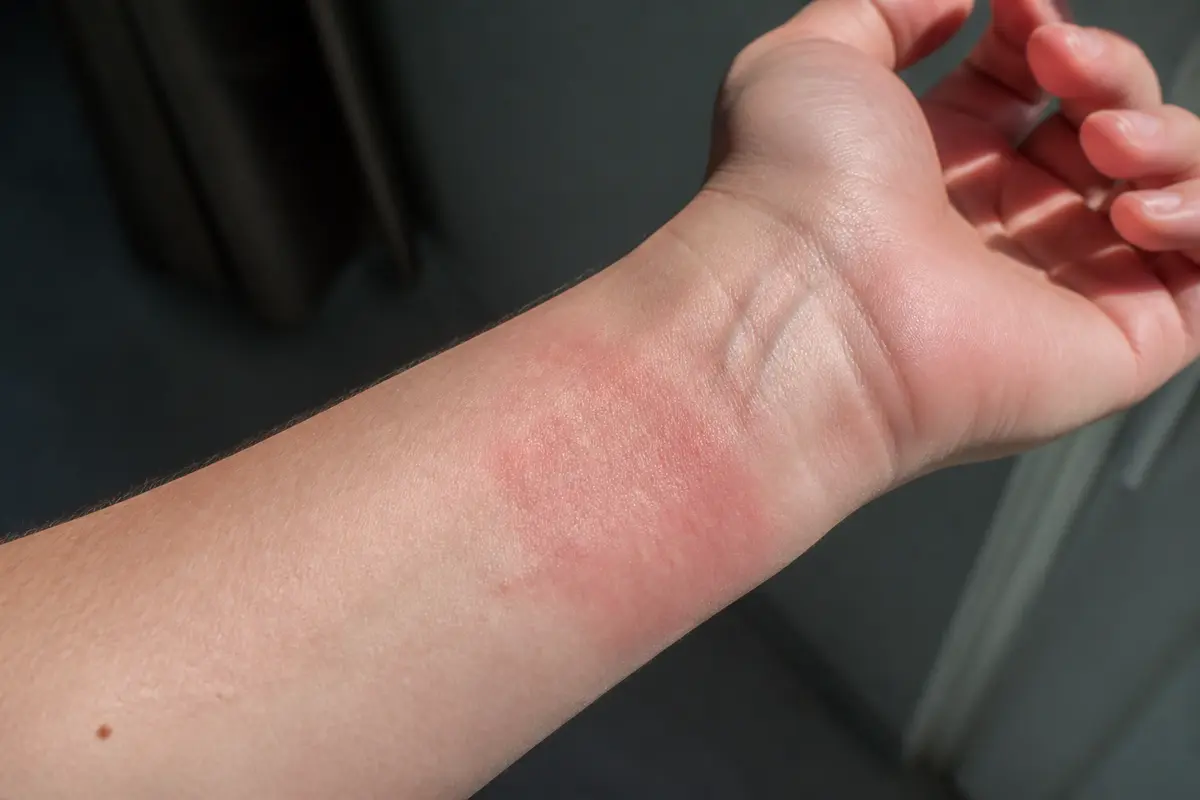 Poignet irrité avec peau rouge, indiquant une démangeaison au niveau du poignet.